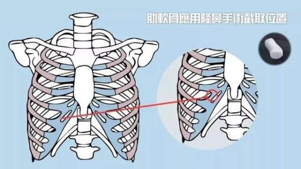 耳软骨、肋软骨、鼻中隔，用它们隆鼻有啥区别？