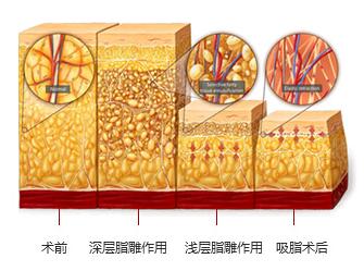 腿部吸脂手术效果如何？会不会产生凹凸不平？(图1)