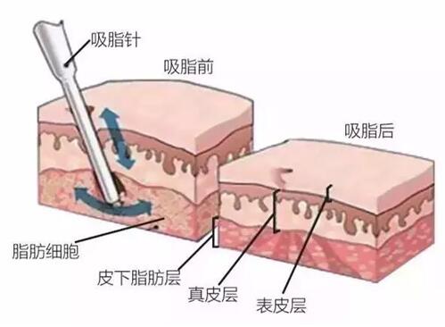 吸脂手术后遗症及其反弹问题是怎么回事？(图1)