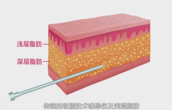 不要轻易吸脂，威塑吸脂也不靠谱？(图2)