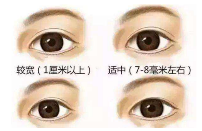 揭秘不同眼型，拥有迷人双眸的整形方法(图3)