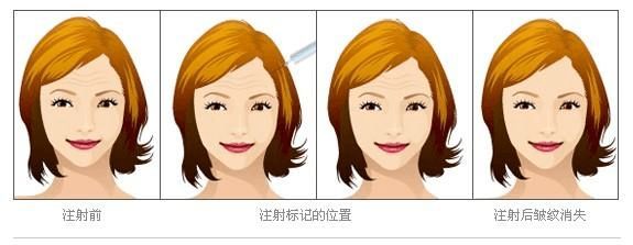 目前常用的除皱治疗方法有哪些(图4) 目前常用的除皱治疗方法有哪些(图4)