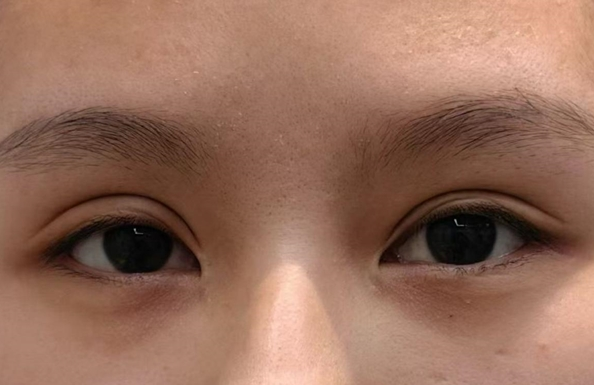 临沂双眼皮怎么选？从审美标准、手术细节与术后护理解析