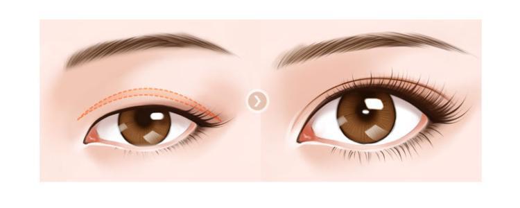 揭秘不同眼型，拥有迷人双眸的整形方法(图1)