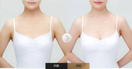 自体脂肪隆胸好吗?隆胸术后要注意什么(图1) 自体脂肪隆胸好吗?隆胸术后要注意什么(图1)